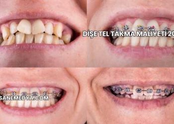 Dişe Tel Takma Maliyeti 2025
